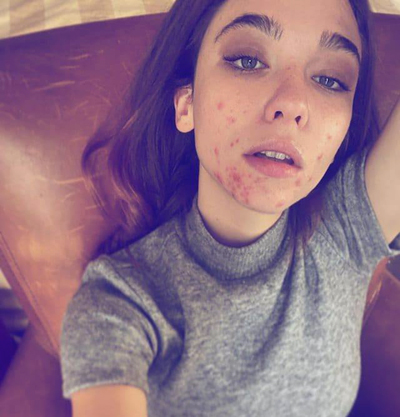 matilda de angelis acne